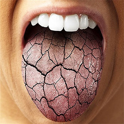 Why Oral Probiotics Help Dry Mouth